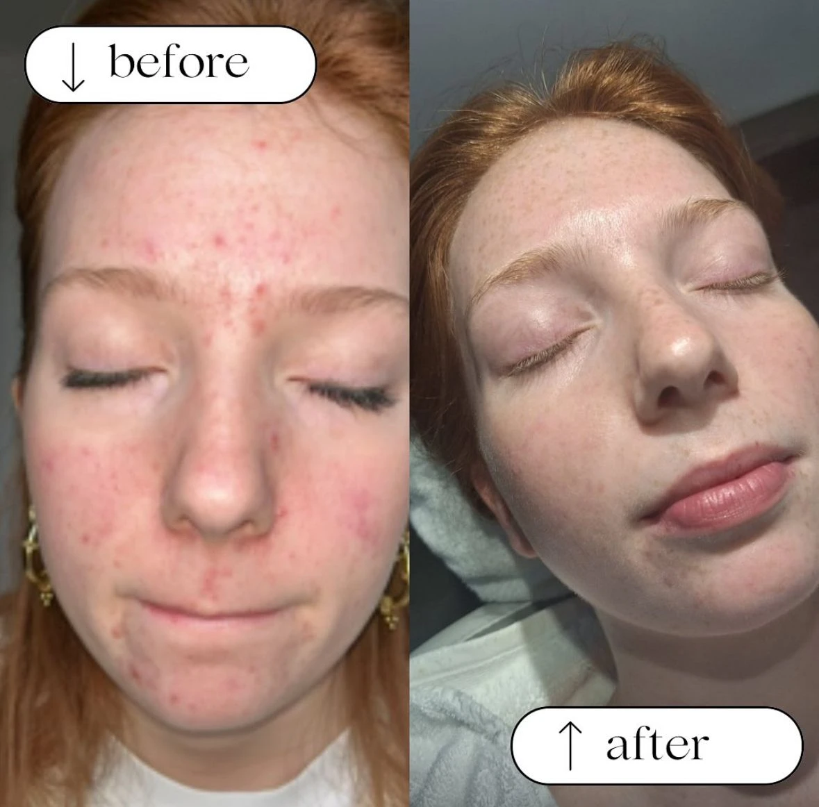 Acne behandeling PRO Clear 