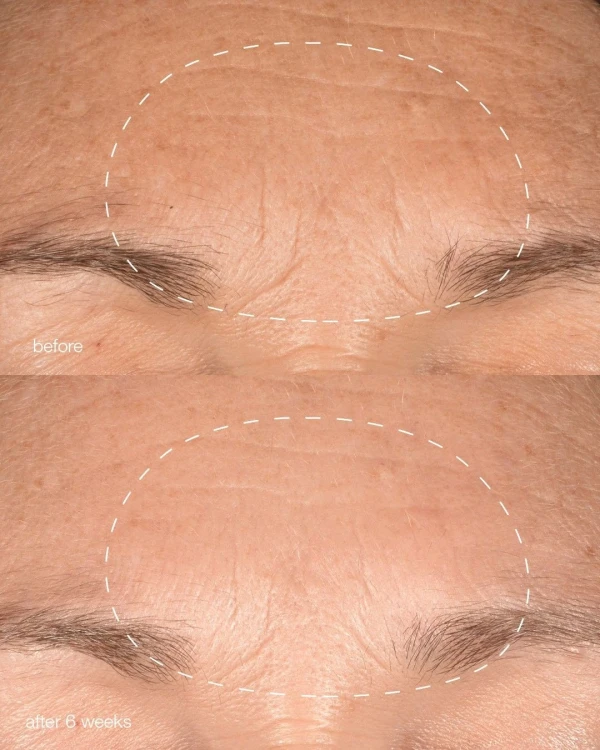 Anti-aging behandeling Leiderdorp
